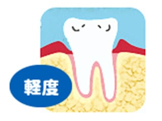 歯周病の図