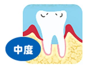 歯周病の図