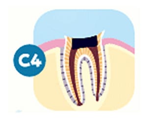虫歯の図