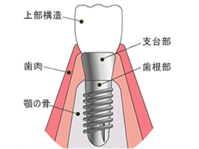 インプラント治療