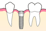 インプラント埋入
