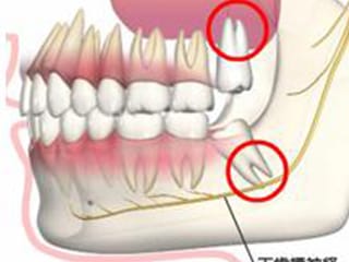 親知らずの抜歯