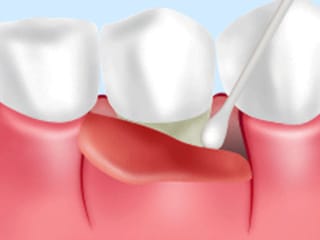 歯周病の外科治療